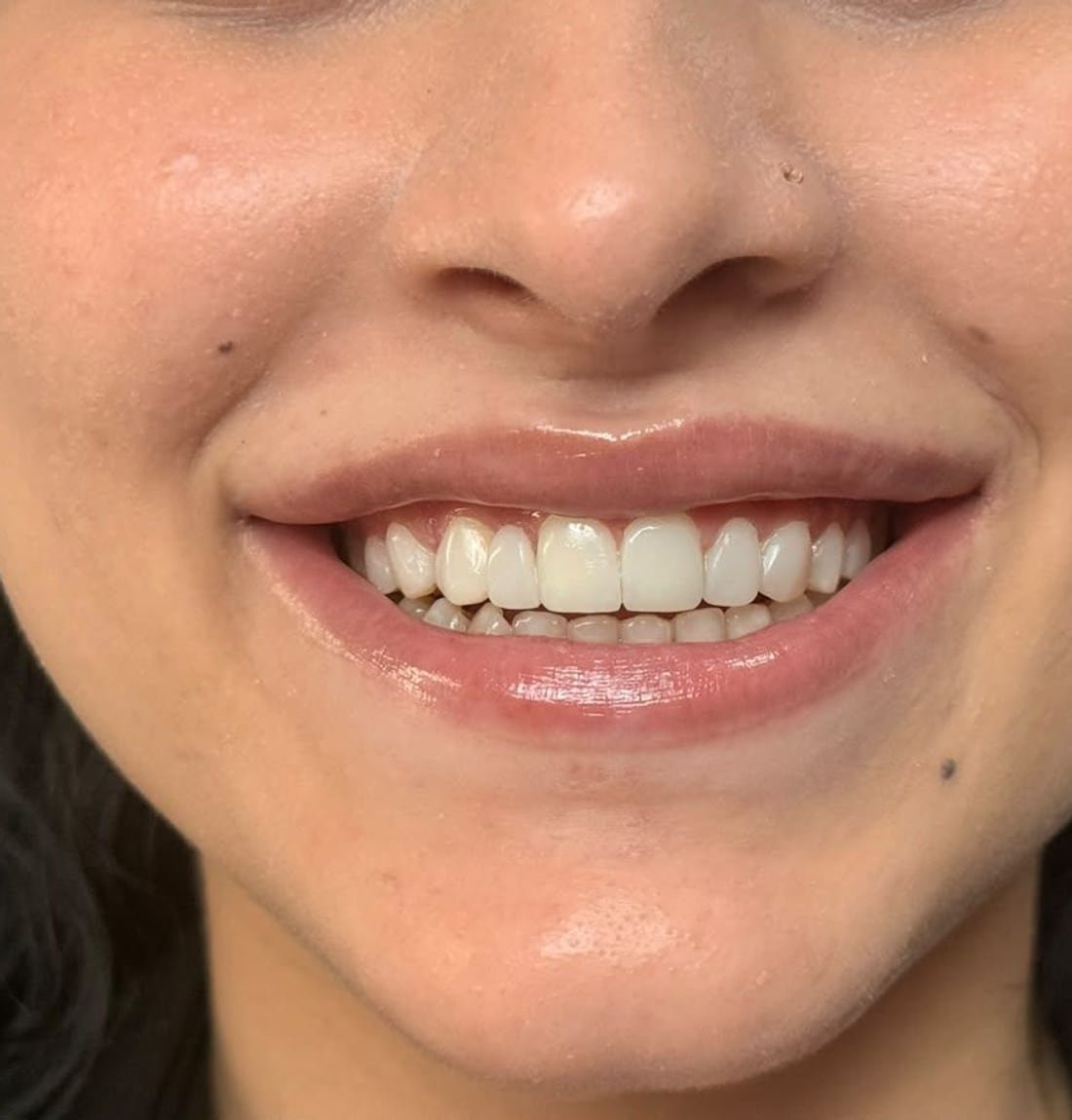 Composite veneers, finished result