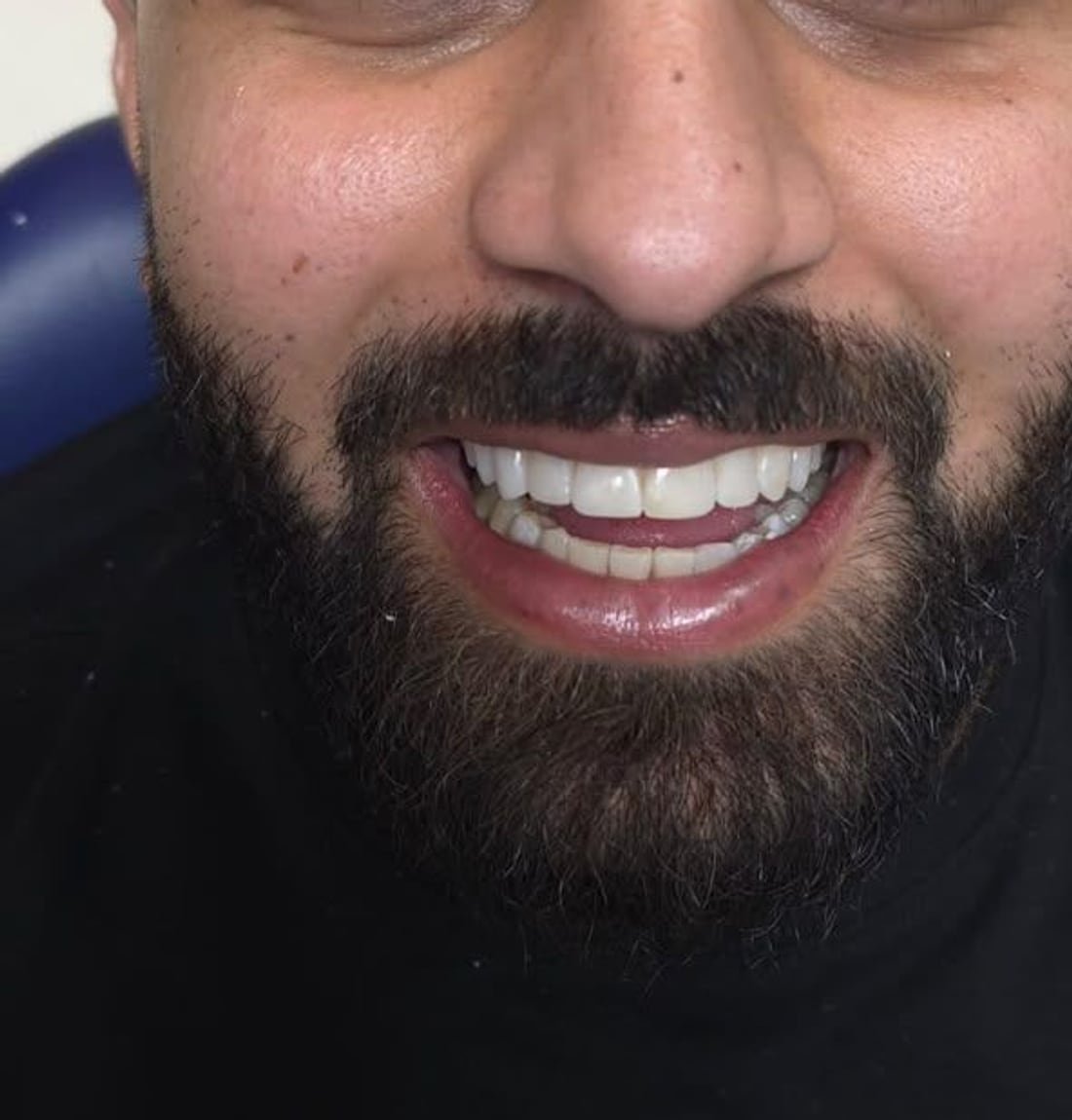 Custom veneers, finished result