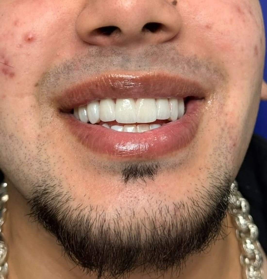 E-Max ceramic veneers, finished result