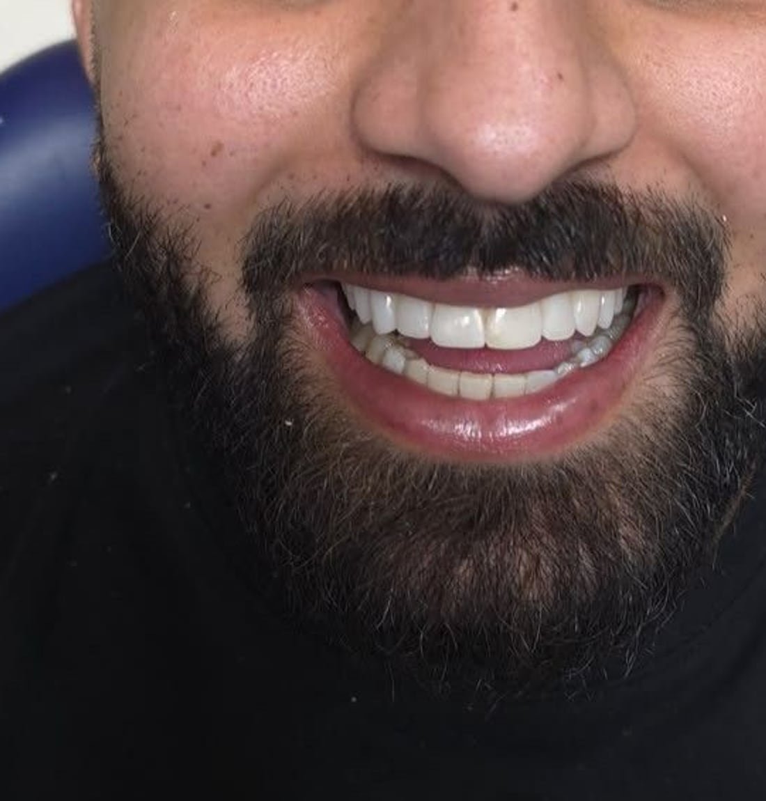Composite bonding, finished result